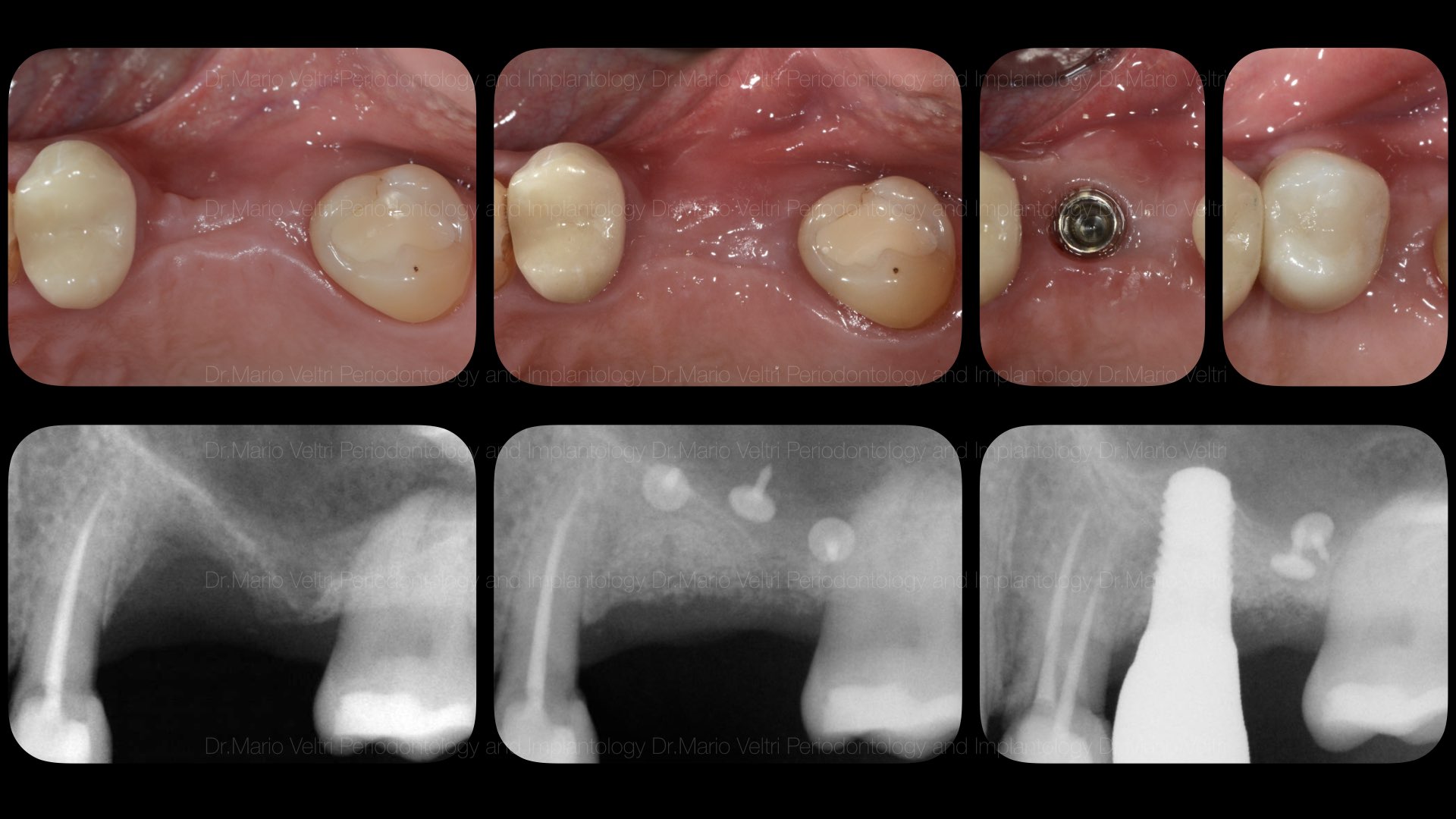 implant regen.008