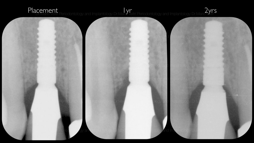 peri-implantits.001